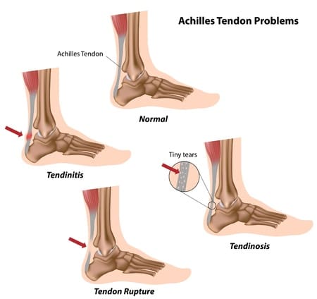 11347639 - achilles tendon problems