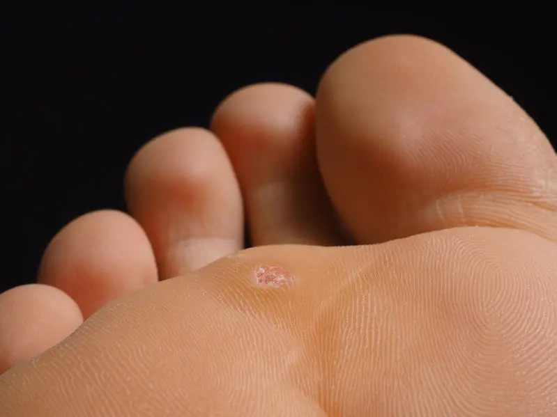 40330226 - closeup of foot with a infected wart placed under toes, isolated towards black